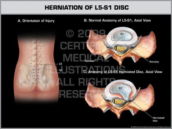 Exhibit of Herniation of L5-S1 Disc.