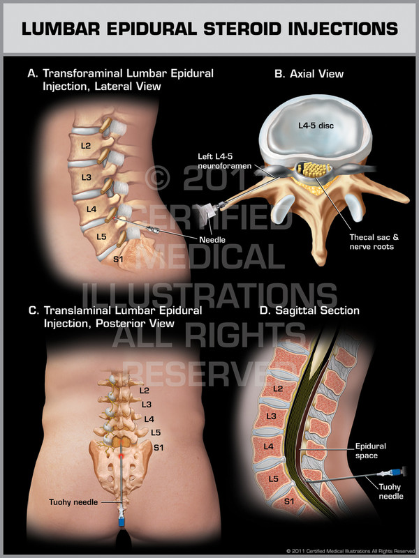 Exhibit of Lumbar Epidural Steroid Injections.