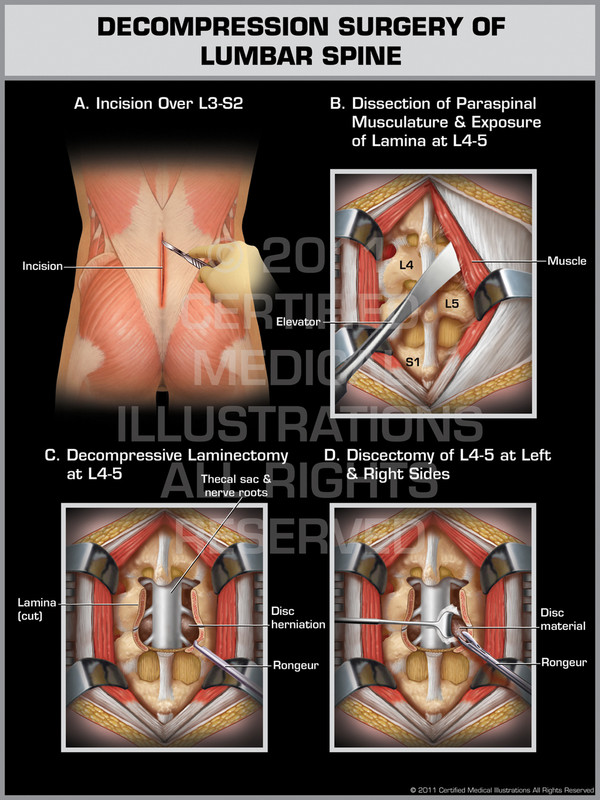 Exhibit of Decompression Surgery of Lumbar Spine.