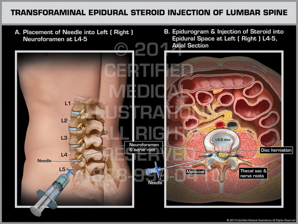 Exhibit of Epidural Steroid Injection of Lumbar Spine.