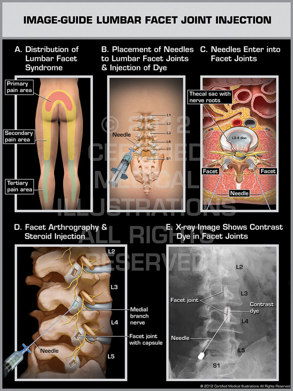 Exhibit of Image-Guide Lumbar Facet Joint Injection Male.