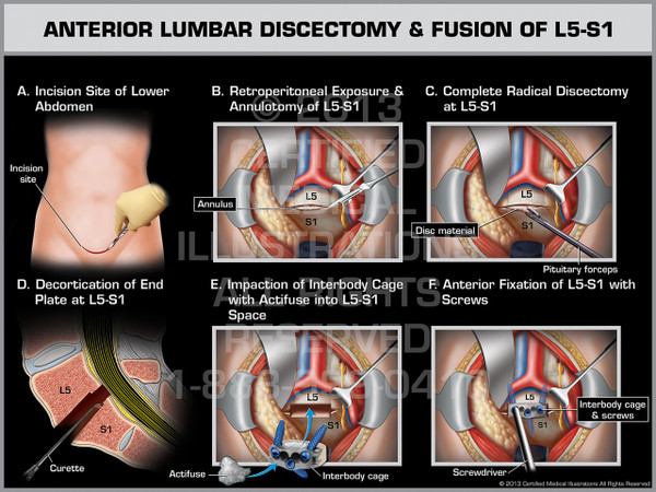 Exhibit of Anterior Lumbar Discectomy & Fusion of L5-S1.