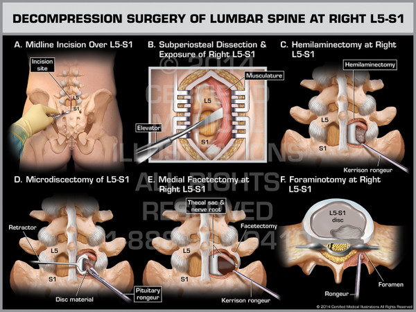 Exhibit of Decompression Surgery of Lumbar Spine at Right L5-S1.