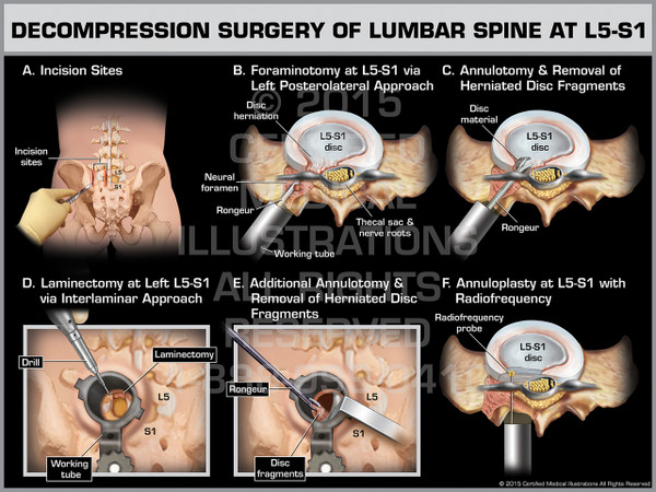 Exhibit of Decompression Surgery of Lumbar Spine at L5-S1.