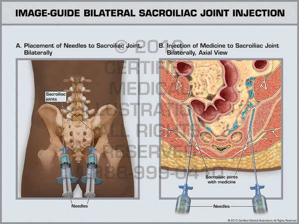 Exhibit of Image-Guide Bilateral Sacroiliac Joint Injection.