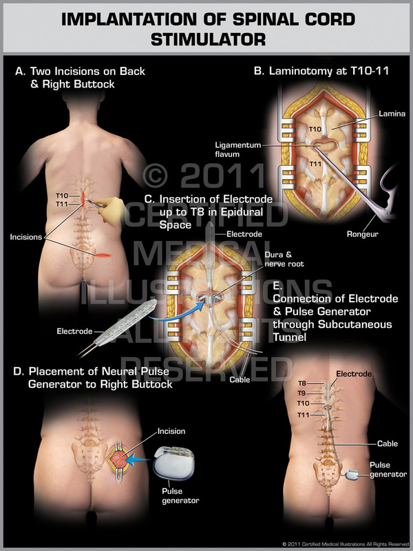 Exhibit of Implantation of Spinal Cord Stimulator Male.