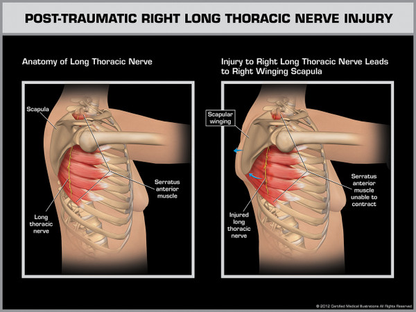 Exhibit of Post-Traumatic Right Long Thoracic Nerve Injury.