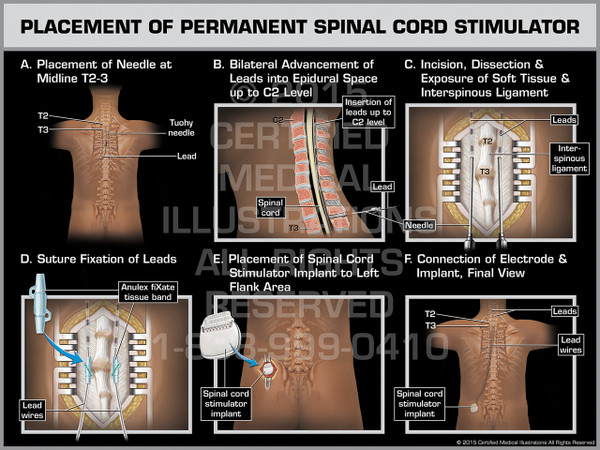 Exhibit of Placement of Permanent Spinal Cord Stimulator Female.