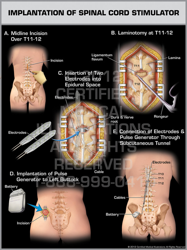 Exhibit of Implantation of Spinal Cord Stimulator Female.