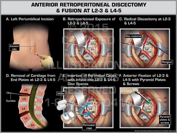 Exhibit of Anterior Retroperitoneal Discectomy & Fusion at L2-3 & L4-5.