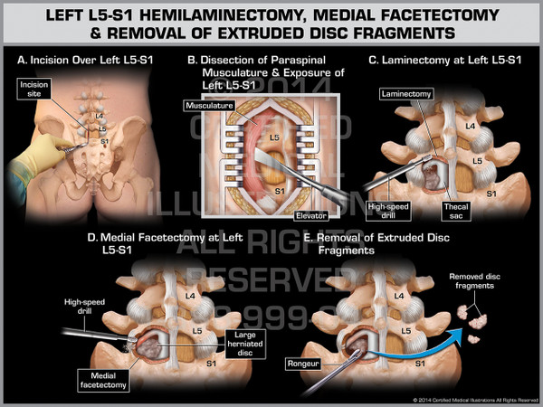 Exhibit of Left L5-S1 Hemilaminectomy, Medial Facetectomy & Removal of Extruded Disc Fragments.