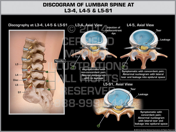 Exhibit of Discogram of Lumbar Spine at L3-4, L4-5 & L5-S1.