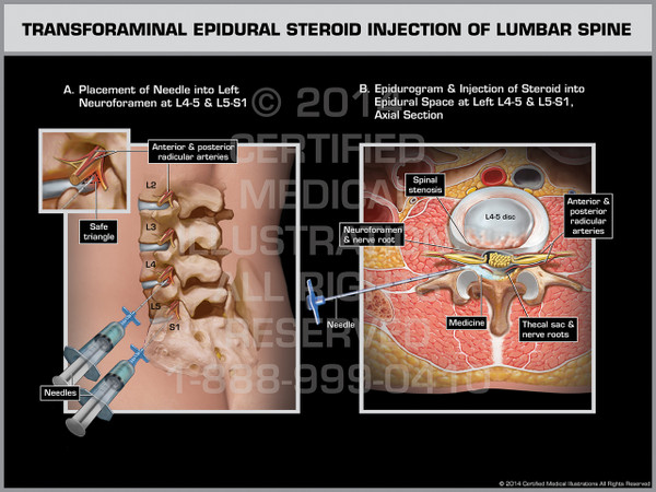 Exhibit of Transforaminal Epidural Steroid Injection of Lumbar Spine.