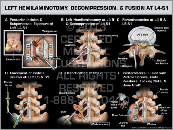 Exhibit of Left Hemilaminotomy, Decompression, & Fusion at L4-S1.