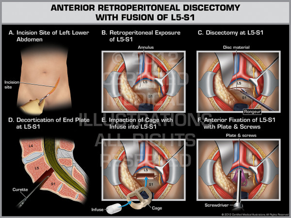 Exhibit of Anterior Retroperitoneal Discectomy with Fusion of L5-S1.