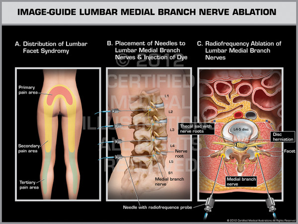Exhibit of Image-Guide Lumbar Medial Branch Nerve Ablation Female.