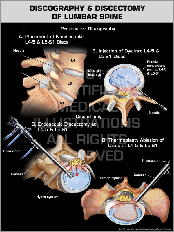 Exhibit of Discography & Discectomy of Lumbar Spine.