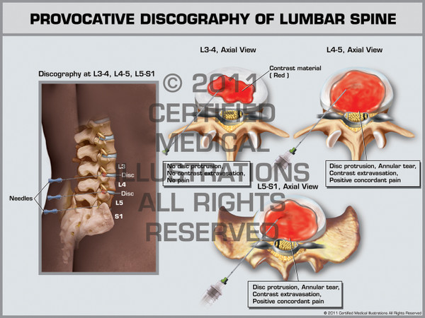 Exhibit of Provocative Discography of Lumbar Spine.