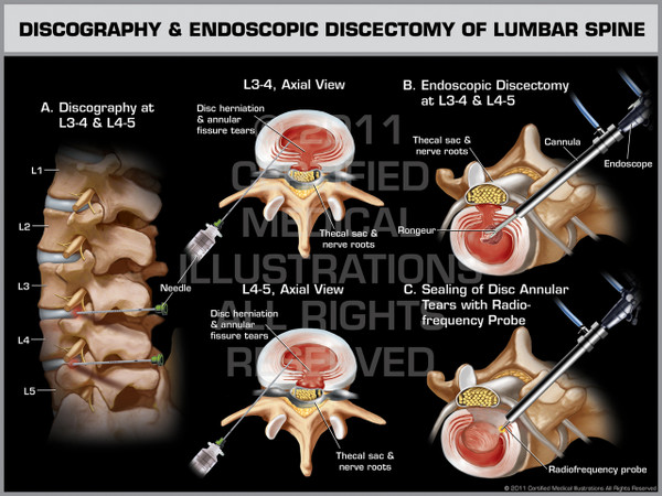 Exhibit of Discography & Endoscopic Discectomy of Lumbar Spine.