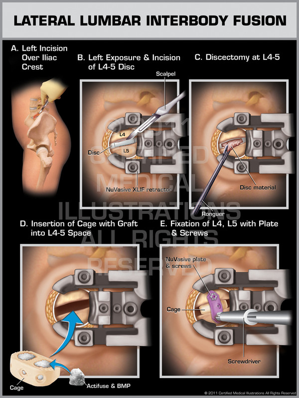 Exhibit of Lateral Lumbar Interbody Fusion.