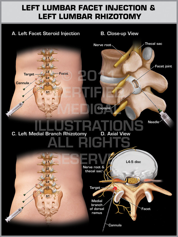 Exhibit of Left Lumbar Facet Injection & Left Lumbar Rhizotomy.