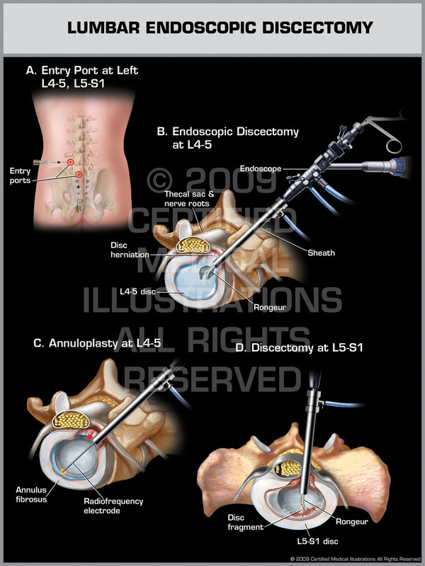 Exhibit of Lumbar Endoscopic Discectomy.
