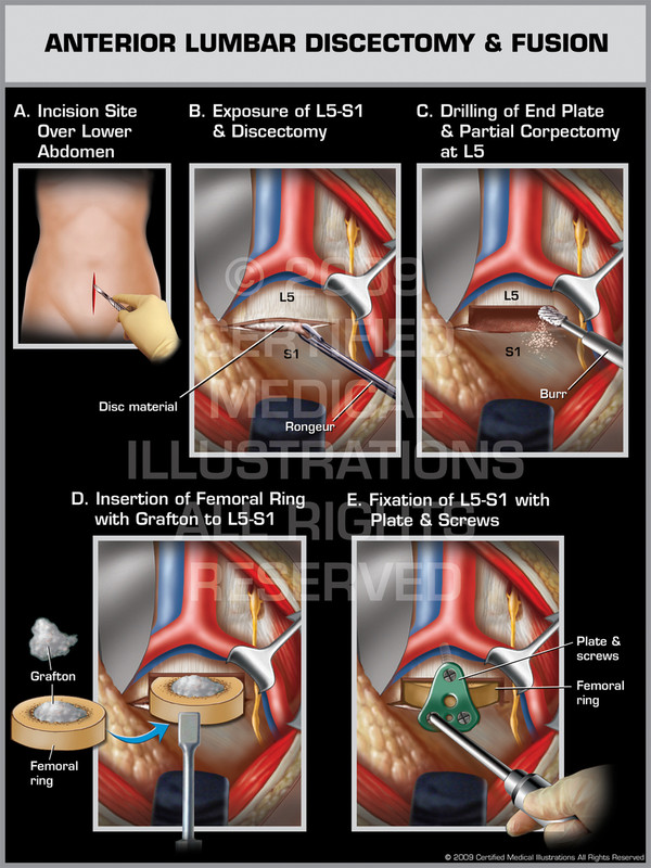 Exhibit of Anterior Lumbar Discectomy & Fusion Female.
