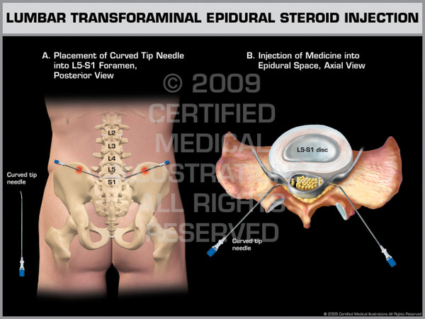 Exhibit of Lumbar Transforaminal Epidural Steroid Injection.