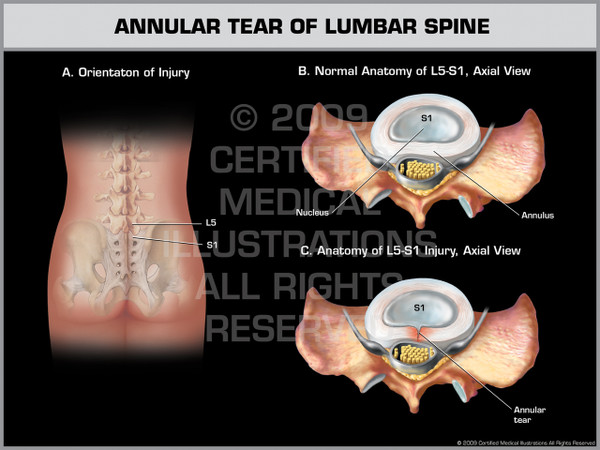 Exhibit of Annular Tear of Lumbar Spine.