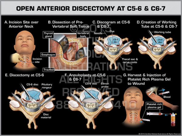 Exhibit of Open Anterior Discectomy at C5-6 & C6-7.