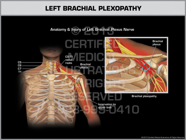 Exhibit of Left Brachial Plexopathy.
