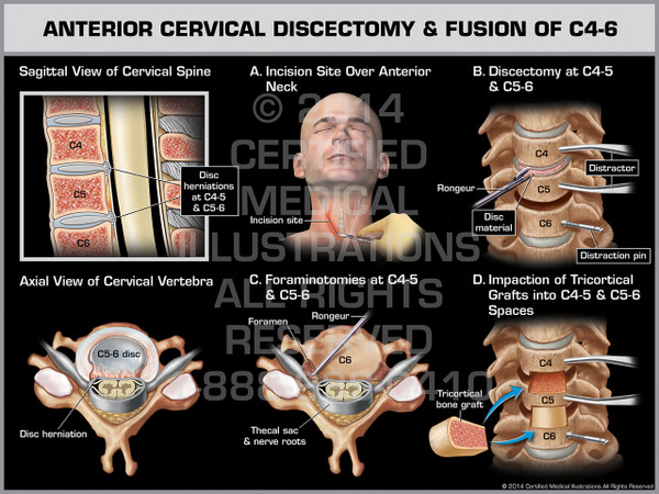 Exhibit of Anterior Cervical Discectomy & Fusion of C4-6.