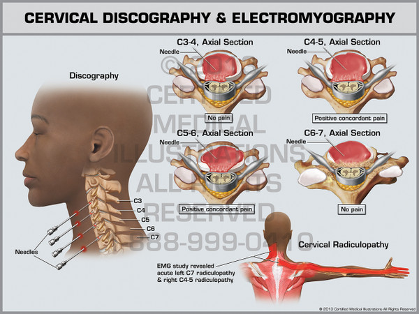 Exhibit of Cervical Discography & Electromyography.
