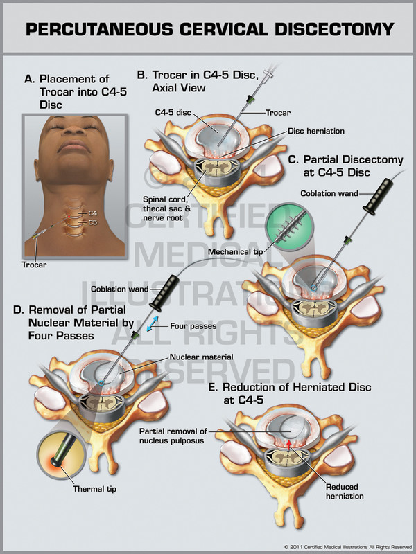 Exhibit of Percutaneous Cervical Discectomy.