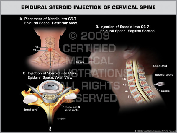 Exhibit of Epidural Steroid Injection of Cervical Spine. Exhibit of Epidural Steroid Injection of Cervical Spine.
