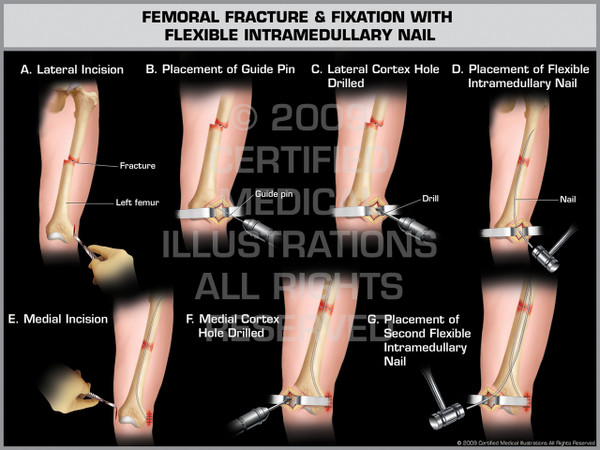 Exhibit of Femoral Fracture & Fixation with Flexible Intramedullary Nail.