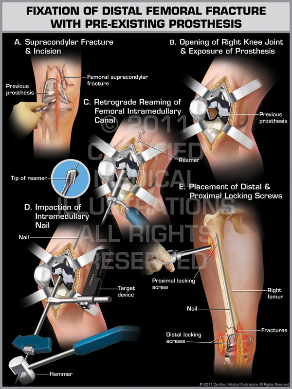 Exhibit of Fixation of Distal Femoral Fracture with Pre-existing Prosthesis