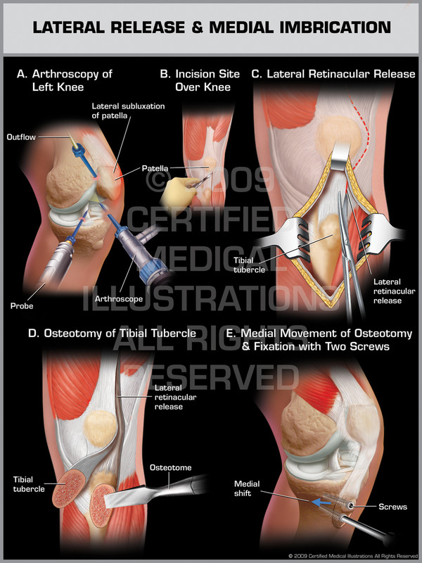 Exhibit of Lateral Release & Medial Imbrication