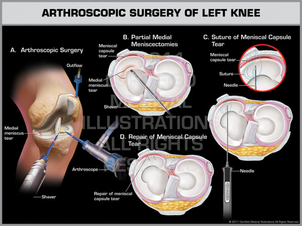 Exhibit of Arthroscopic Surgery of Left Knee 1