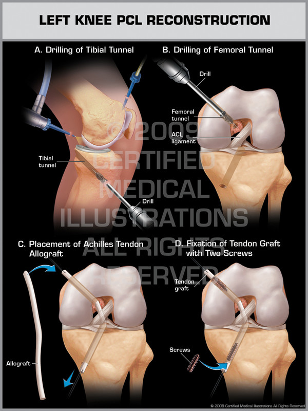Left Knee PCL Reconstruction