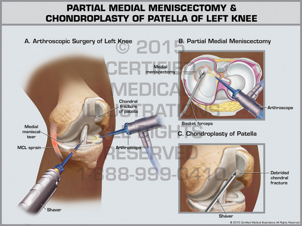 Partial Medial Meniscectomy & Chondroplasty of Patella of Left Knee