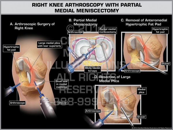Right Knee Arthroscopy with Partial Medial Meniscectomy