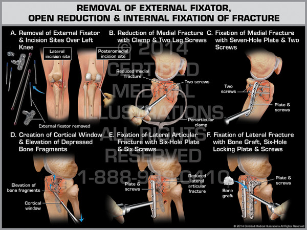 Exhibit of Removal of External Fixator, Open Reduction & Internal Fixation of Fracture.