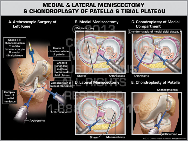 Exhibit of Medial & Lateral Meniscectomy & Chondroplasty of Patella & Tibial Plateau.