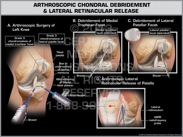 Exhibit of Arthroscopic Chondral Debridement & Lateral Retinacular Release.