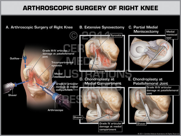 Exhibit of Arthroscopic Surgery of Right Knee.