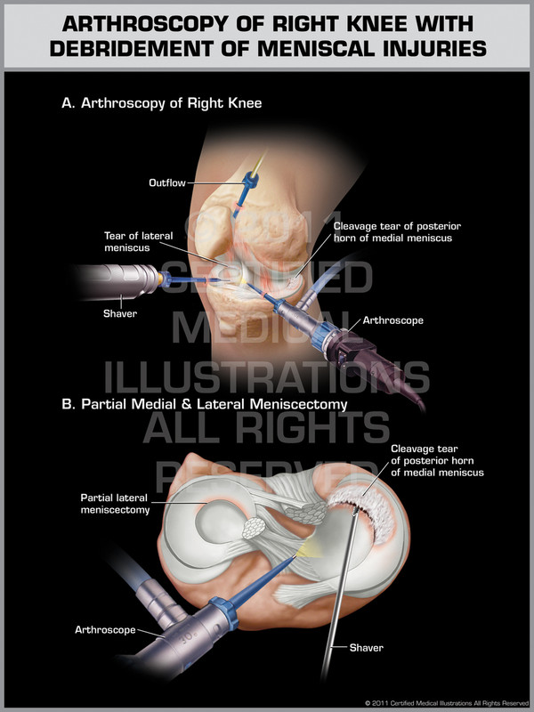 Exhibit of Arthroscopy of Right Knee with Debridement of Meniscal Injuries.