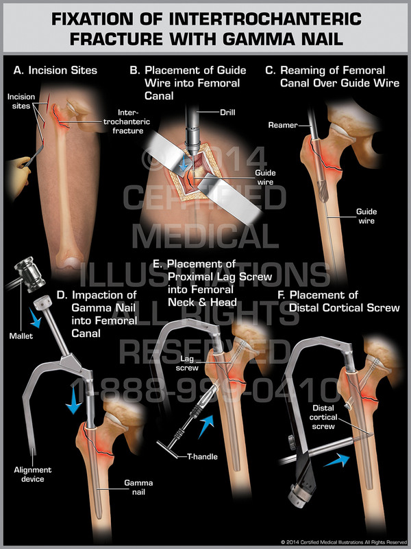 Exhibit of Fixation of Intertrochanteric Fracture with Gamma Nail.