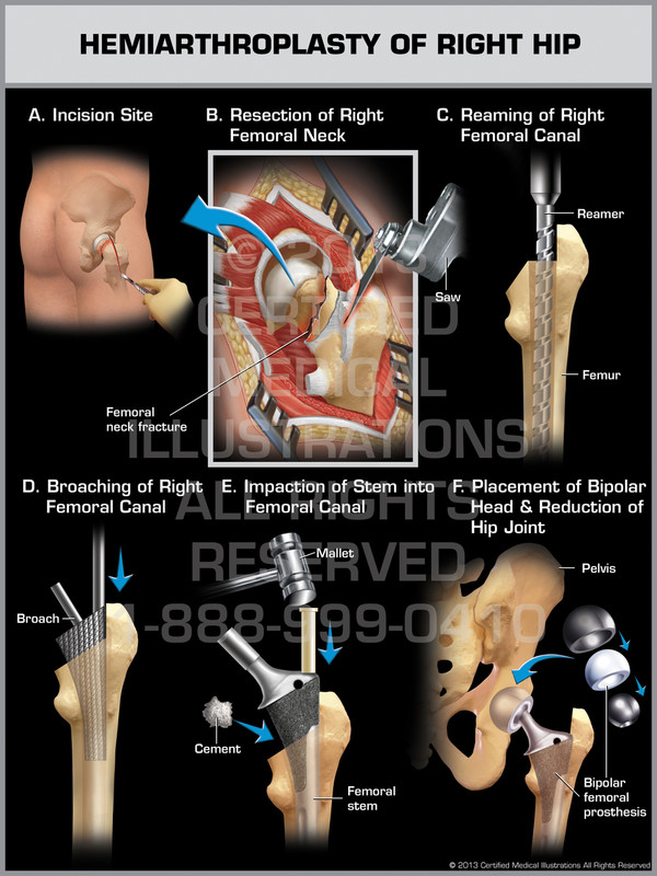 Exhibit of Hemiarthroplasty of Right Hip.