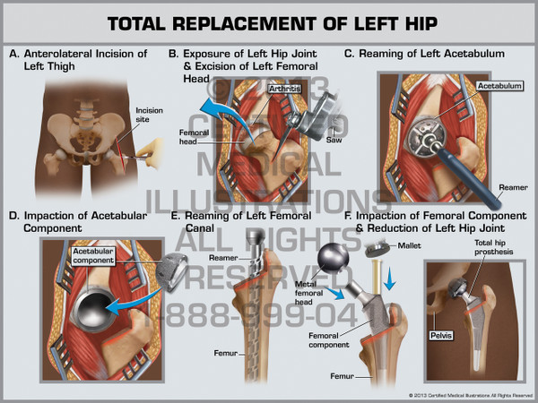 Exhibit of Total Replacement of Left Hip.